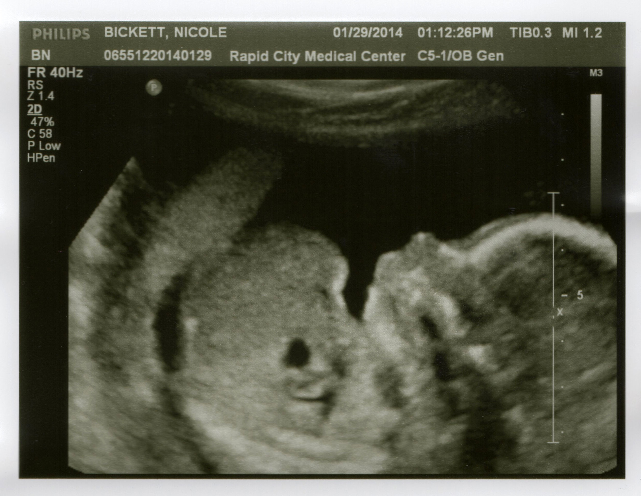 The profile at 20 weeks — January 29, 2014.