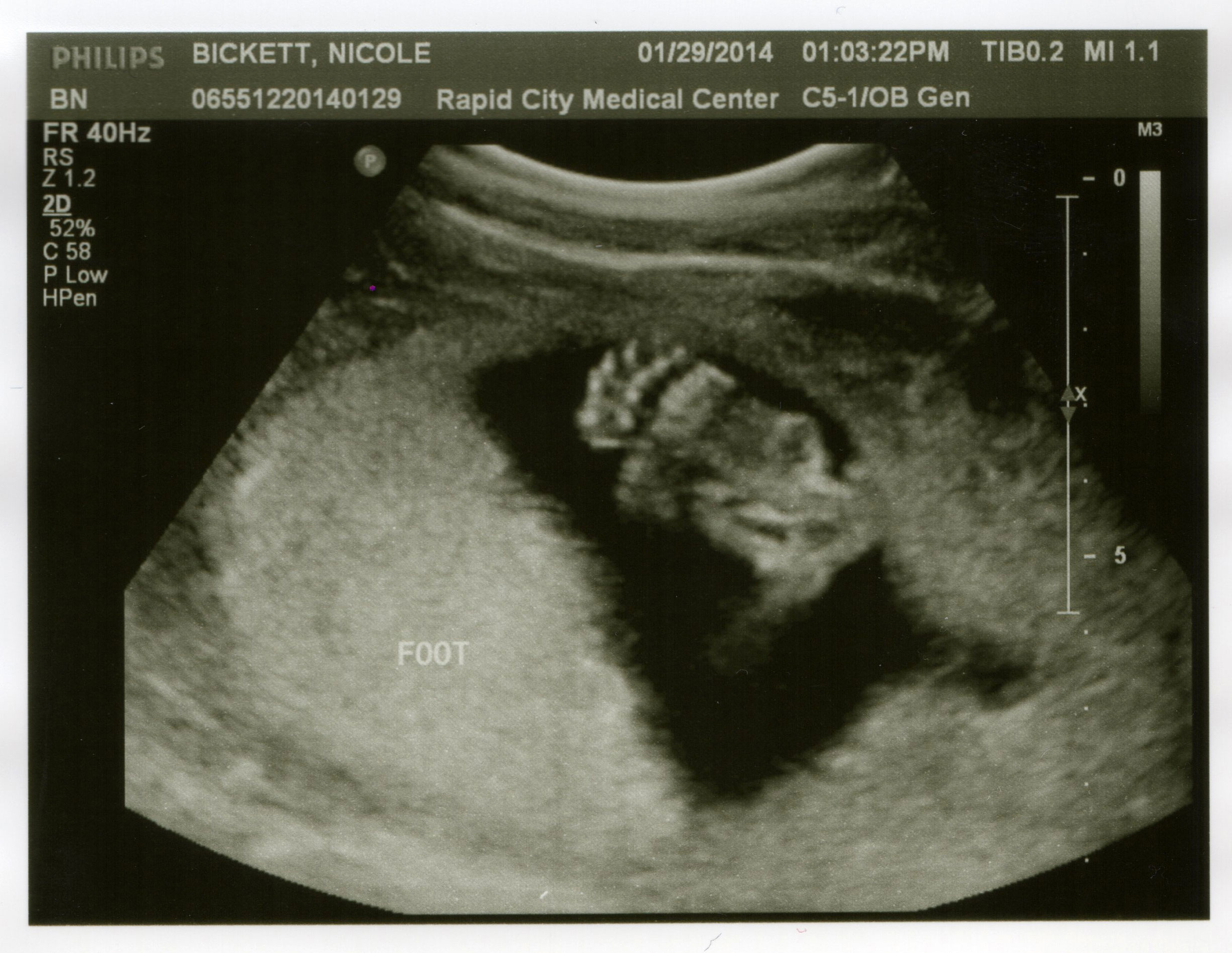 The foot at 20 weeks — January 29, 2014.