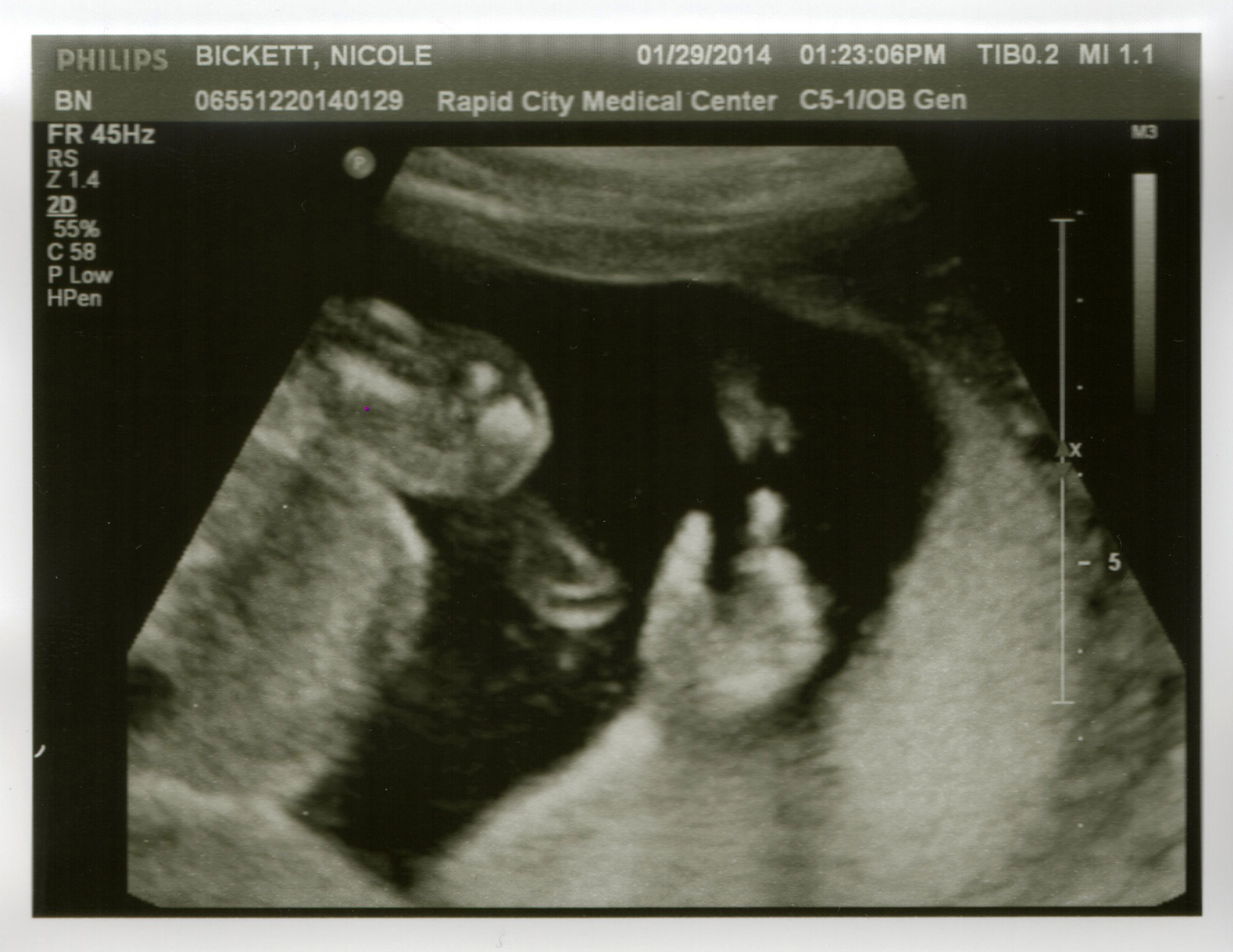 The hand at 20 weeks — January 29, 2014.